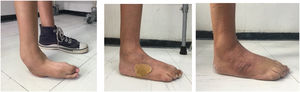 paciente de 19 años con pie equino varo derecho manejado con MP, tenotomía del Aquiles y transferencia de tibial anterior a 3 cuña, donde se observa zona de presión en región lateral del dorso del pie y reabsorción de la misma en un espacio de 3 meses luego de la cirugía.