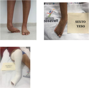 paciente de 14 años con PEVC derecho sin tratamiento, manejado con MP quien se logro corrección al sexto yeso, realizándose cirugía con tenotomía percutánea del Aquiles y transferencia del tibial anterior a 3 cuña.