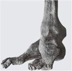 PEVC de la momia egipcia del faraón Siptah. Tomado de Hernigou y cols (4).