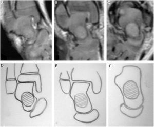 Imagen de RNM y gráfico de la articulación talonavicular que muestra la corrección progresiva de la inclinación, desplazamiento y remodelación de la forma del talo y del navicular después de utilizar enyesados seriados mediante método de Ponseti. Tomado de Pirani (48).