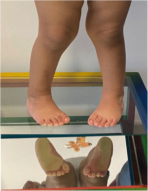 Podoscopia en niño de 2 años con recidiva.