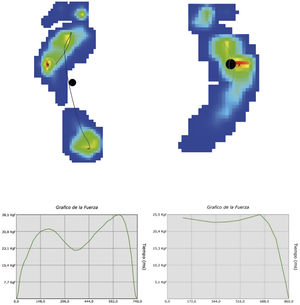 Baropodometría. Pie derecho: PEVC recidivado. Hay apoyo en toda la columna externa con presión máxima en quinto metatarsiano y cuboides. El centro de gravedad está desplazado hacia el cuboides. No hay apoyo del talón. Pie izquierdo: pie normal.