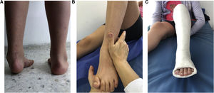 A. Pie equino varo recidivado después de liberación postero interna. B Técnica de manipulación en niño mayor. C. Pie parcialmente corregido con yeso inguinopédico.