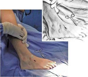 Localización de la cuña lateral.