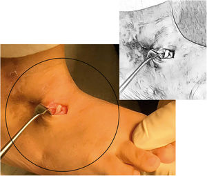 Se debe asegurar que el tendón se deslice dentro del túnel óseo en la cuña lateral.