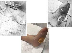 Fijación plantar. técnica ̈pull-ouẗ con botón.