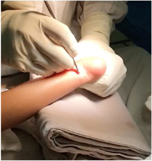 Giro de 90° de la hoja de bisturí mientras se hace dorsiflexión del tobillo.
