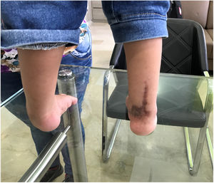 Cicatriz hipertrófica, secuela de LIPIA.