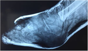Radiografía que muestra errores del enyesado con moldeo inadecuado.