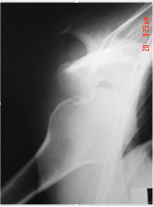 Anterior view of glenohumeral dislocation using the proposed radiographic projection.