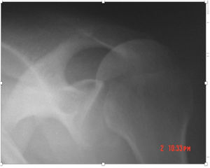 Posterior view of glenohumeral dislocation using the proposed radiographic projection.