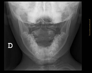 Radiografía simple de columna cervical transoral.