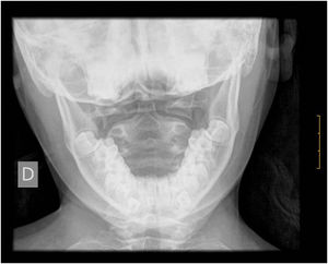 Radiografía transoral cervical postratamiento.