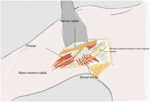 Abordaje axilar: esquema evidenciando la presencia de la primera rama motora del nervio radial sobre el tendón del Latissimus Dorsi.