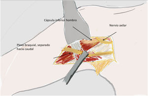 El nervio axilar se localizó en un triángulo delimitado por el tendón del Latissimus Dorsi, la arteria Circunfleja posterior, y la arteria subescapular.