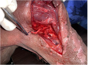 Abordaje posterior longitudinal del hombro: Se muestra la rama anterior del Nervio Axilar, seccionada por el abordaje anterior para anastomosis con la rama motora el nervio axilar.