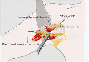 Distancia de la Rama Motora del Nervio Axilar al tendón del Teres Minor. (DRMA-TM).