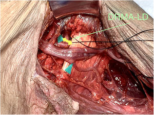 Distancia de la Rama Motora del Nervio Axilar al tendón del Latissimus Dorsi. (DRMA-LD).