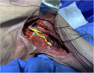 Relación entre primera rama motora del Nervio Radial al tendón del Latissimus Dorsi.