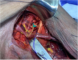 Neurotización de rama motora anterior de Nervio Axilar con primera rama motora del Nervio Radial.