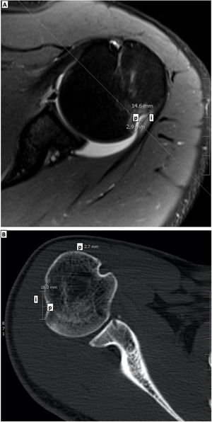 A–1B. Medición de la profundidad (p) y el intervalo (i) del defecto de Hill-Sachs en corte axial de imagen de resonancia magnética secuencia T2-Saturación Grasa (1A), y corte axial en imagen por tomografía simple (1B).