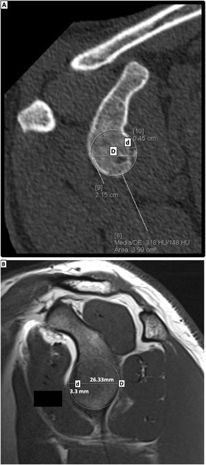 A-2B. Medición del diámetro glenoideo (D) y del defecto glenoideo anteroinferior (d) en corte sagital de imagen por tomografía simple (2A) y corte sagital en imagen por resonancia magnética, secuencia T1-TSE (2B).