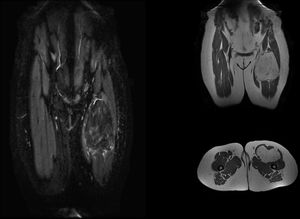 Imágenes de RMN del tumor.