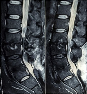 RM sagital lumbar, 6 meses pop, se observa resolución de espondilodiscitis y absceso, ya sin material quirúrgico.