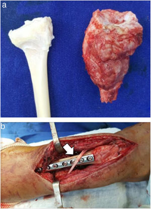 Paciente 1. a. Pieza resecada de TCG a la derecha y aloinjerto a la izquierda. b. Imagen quirúrgica de fijación de aloinjerto de radio distal. Flecha indica localización de Extensor Pollicis Longus. Derecha de la imagen corresponde a localización distal.