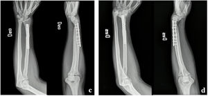 Paciente 1. c. Radiografía postquirúrgica con fijación de aloinjerto con placa DCP. d. Radiografía de seguimiento 1 año y 6 meses tras procedimiento. Nótese luxación palmar radiocarpiana sin recidiva tumoral.