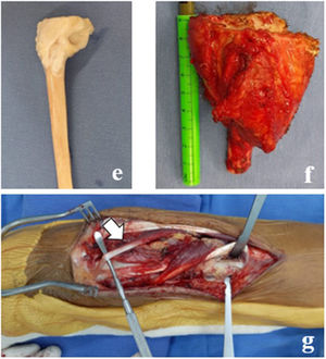 Paciente 2. e y f. Pieza resecada de TCG a la derecha y aloinjerto a la izquierda. g. Imagen quirúrgica de fijación de aloinjerto de radio distal. Flecha indica localización de Extensor Pollicis Longus. Izquierda de la imagen corresponde a localización distal.