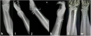 Paciente 2. h, i. Radiografía prequirúrgica con masa en radio distal radiolúcida y lítica con apariencia geográfica y apolillada que se extiende del hueso subcondral a la metáfisis y epífisis distal. j, k. Radiografías postquirúrgicas, fijación con placa LC - LCP y clavos de kirschner en ARCD y radiocarpiana. l,m. Radiografías de seguimiento a los 6 meses de cirugía.