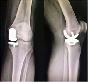 Prótesis unicompartimental de nuestra serie de casos vista en RX AP y lateral de rodilla izquierda.