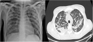 Radiografía AP de Tórax (Izquierda). Lesiones micro nodulares diseminadas en ambos campos pulmonares con lesiones nodulares apicales. Tomografía axial computarizada de alta resolución – TACAR (Derecha). Extensas opacidades en vidrio deslustrado y extenso infiltrado intersticial reticular micronodular diseminado universalmente en los campos pulmonares.
