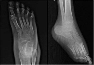 Radiografía AP (izquierda) y lateral (derecha) de pie izquierdo. Marcada osteopenia, edema de los tejidos blandos.