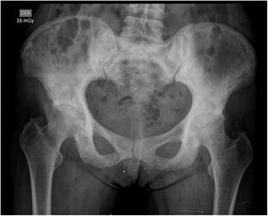 Radiografía de pelvis con áreas de esclerosis difusas a nivel del sacro y los iliacos con áreas de lesiones líticas a nivel de los alerones iliacos.