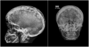 Radiografías lateral y AP de cráneo con un engrosamiento difuso de la tabla ósea de la bóveda craneana y áreas de lesiones blásticas y líticas difusas en el cráneo.