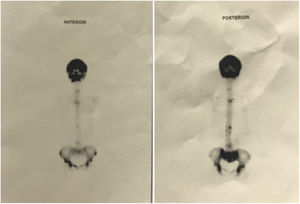 Gammagrafía ósea de 3 fases con lesiones osteoblásticas sobre el esqueleto axial en particular a nivel del cráneo y la pelvis sugestivas de incremento de actividad osteoblástica de origen infiltrativo.