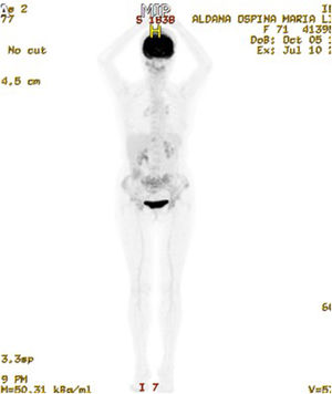 PET-CT con compromiso óseo extenso lítico y blástico en el esqueleto axial comprometiendo en particular el cráneo y los huesos pélvicos.