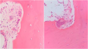 Cortes de estudio histopatológico de biopsia de hueso iliaco evidenciando conglomerados de osteoclastos multinuclerados evidenciando un aumento de la actividad reabsortiva ósea. Fuente: estudio histopatológico de hueso iliaco de la paciente.
