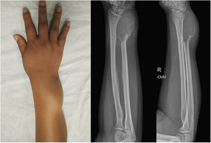 Hallazgo clínico preoperatorio (A). Radiografía anteroposterior (B) y lateral (C) del antebrazo que muestran una lesión osteolítica lobulada y expansiva en el extremo distal del cúbito derecho.