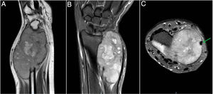 La resonancia magnética (RM): el corte sagital potenciado en densidad de protones de la muñeca muestra una lesión expansiva del cúbito distal con intensidad de señal heterogénea (A). La imagen coronal muestra una lesión lobulada y heterogénea con predominio de alta señal STIR (B). La imagen axial muestra que el tendón del extensor cubital del carpo está envuelto por la masa (C).