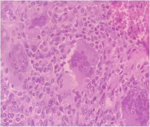Examen histológico (40X) de la biopsia muestra células intersticiales mononucleares y células gigantes multinucleadas.
