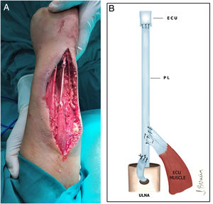 Fotografía intraoperatoria donde se ha estabilizado el muñón cubital con autoinjerto de palmaris longus (PL) y reconstruido el extensor carpi ulnaris (ECU) (A). dibujo esquemático del procedimiento quirúrgico (B).