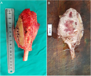 Resección del tumor dentro de los márgenes óptimos (A). Hallazgo macroscópico, la superficie del corte muestra un tejido blanquecino con áreas rojo amarronadas y externamente el tendón extensor carpi ulnaris seccionado (B).