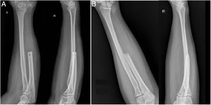 Radiografías al mes postoperatorio (A). Radiografías a los 2 años 5 meses (B).