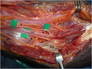 Los reparos son los mismos señalados anteriormente en las otras figuras. Se quiere mostrar la arcada aponeurótica del FDS que cubre el NM.