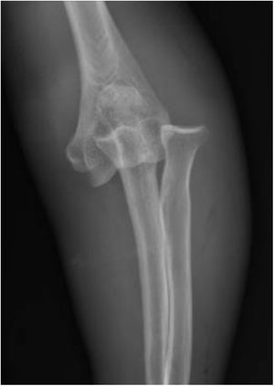 Radiografía Anteroposterior (AP) de codo izquierdo. Luxación postero-lateral simple de codo. No se evidencian trazos de fractura.