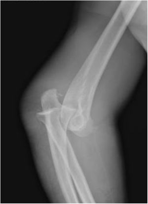 Radiografía lateral de codo izquierdo. Luxación postero-lateral simple de codo.