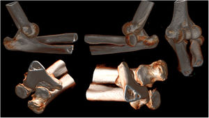 Tomografía axial computarizada (TAC) con reconstrucción 3D de codo izquierdo. Luxación postero-lateral simple de codo. No se evidencian trazos de fractura asociadas que expliquen la inestabilidad.